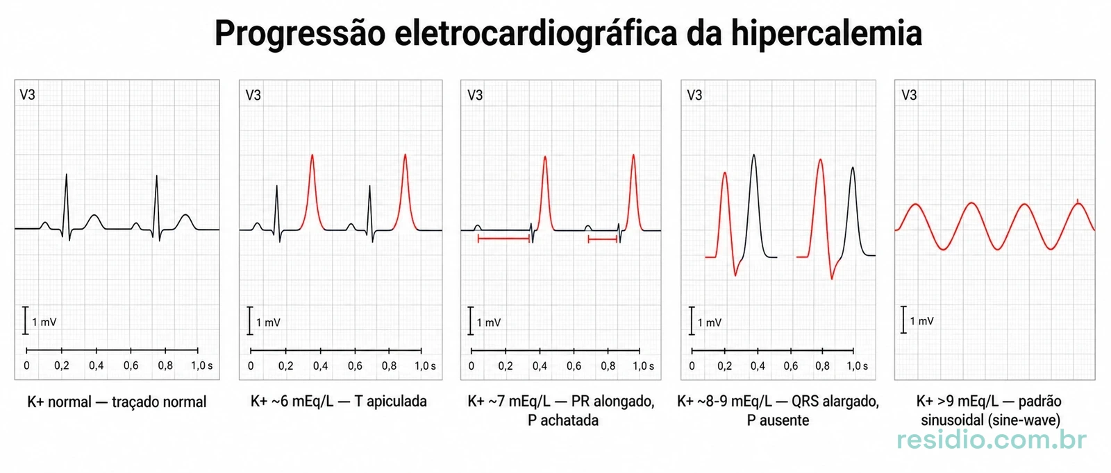 Sequência de cinco tiras de ECG mostrando a progressão da hipercalemia: traçado normal, onda T apiculada, PR alongado com onda P achatada, QRS alargado sem onda P, e padrão sinusoidal final.
